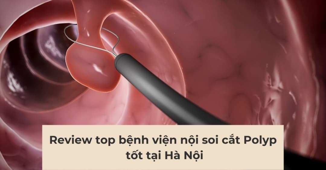 Nội soi cắt polyp ở đâu tốt tại Hà Nội: Đánh giá 7 bệnh viện hàng đầu