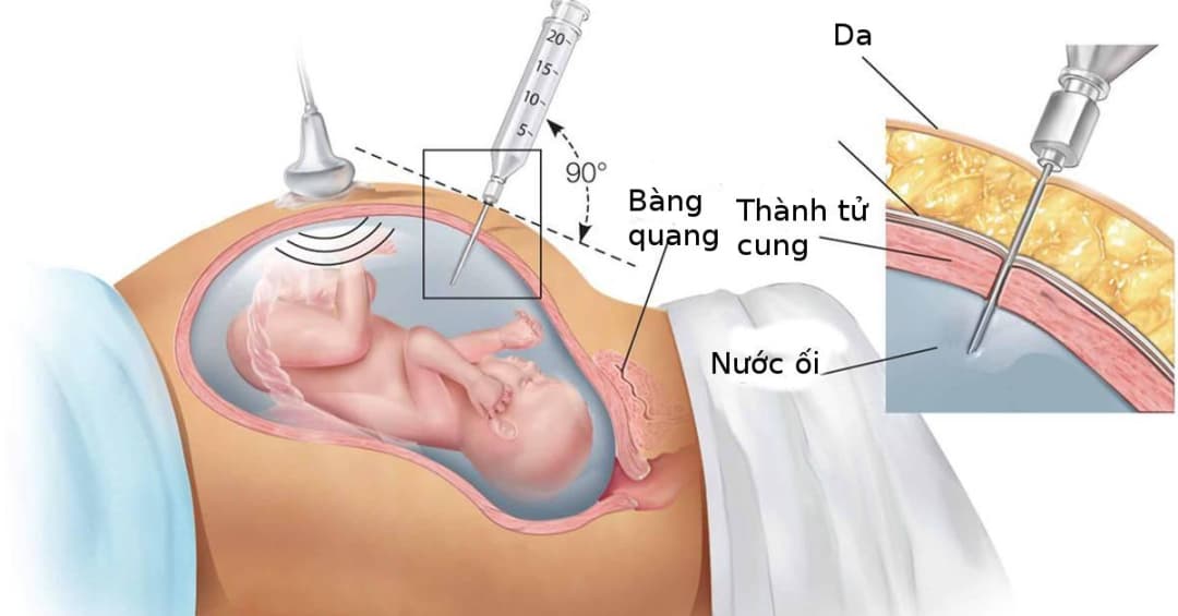 Địa chỉ Sàng Lọc Trước Sinh và Sơ Sinh Tại Hà Nội