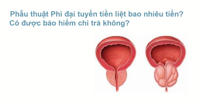 Chi phí phẫu thuật phì đại tuyến tiền liệt là bao nhiêu? 