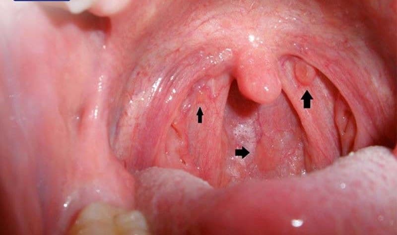 Dấu Hiệu Ung Thư Vòm Họng Giai Đoạn Đầu: Những Triệu Chứng Cần Lưu Ý