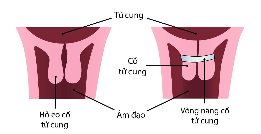 Khâu eo tử cung: Địa chỉ thực hiện và chi phí tại các bệnh viện