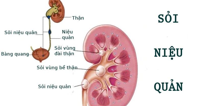 5 cơ sở uy tín khám và điều trị sỏi niệu quản tại Hà Nội