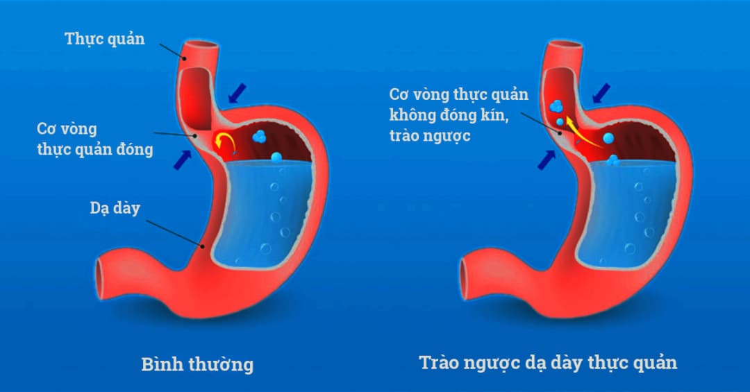 6 vấn đề quan trọng cần biết về Trào ngược dạ dày thực quản