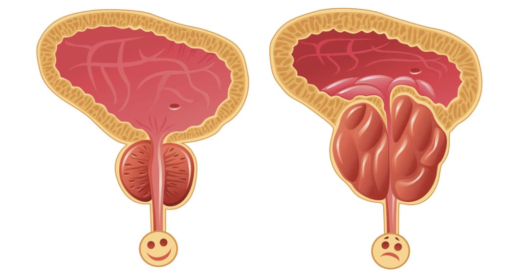 7 cơ sở khám và điều trị phì đại tuyến tiền liệt uy tín tại Hà Nội