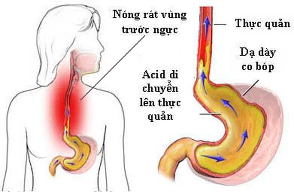 5 địa chỉ khám trào ngược dạ dày thực quản đáng tin cậy tại Hà Nội
