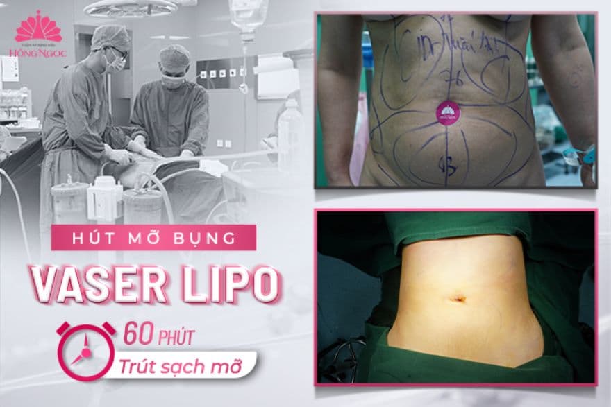 Hút mỡ bụng Thẩm mỹ Bệnh viện hồng ngọc bằng công nghệ Vaser Lipo - 60 phút trút sạch mỡ