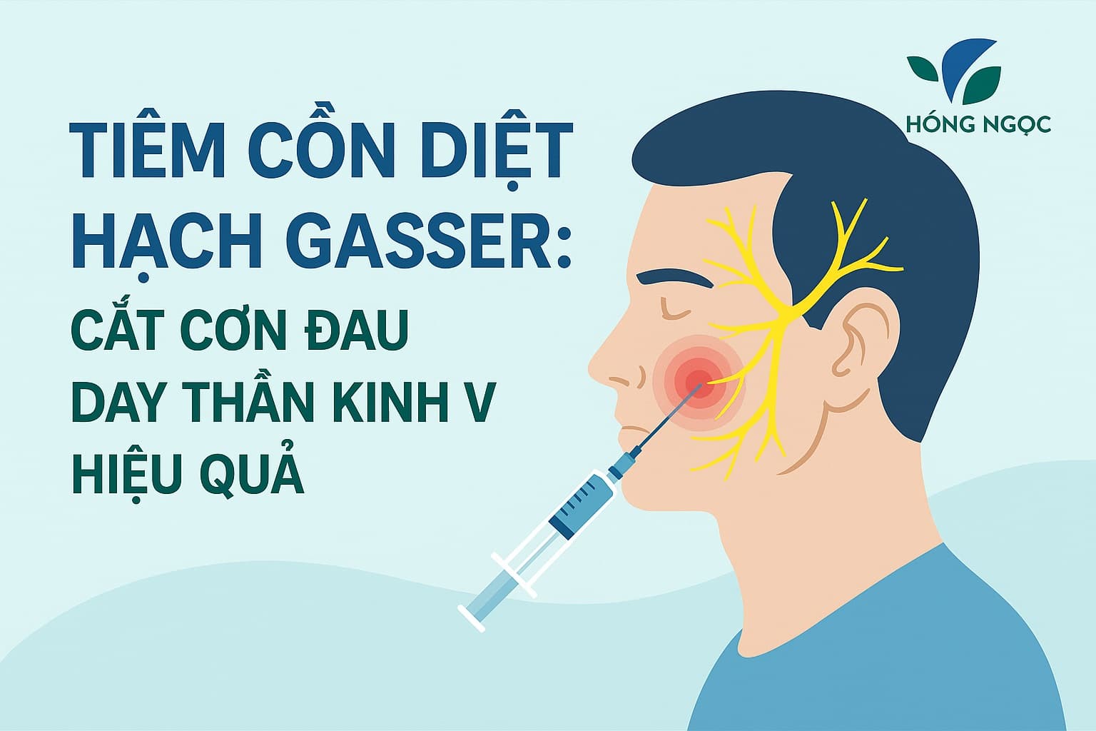 Tiêm cồn diệt hạch Gasser: Cắt cơn đau dây thần kinh V hiệu quả