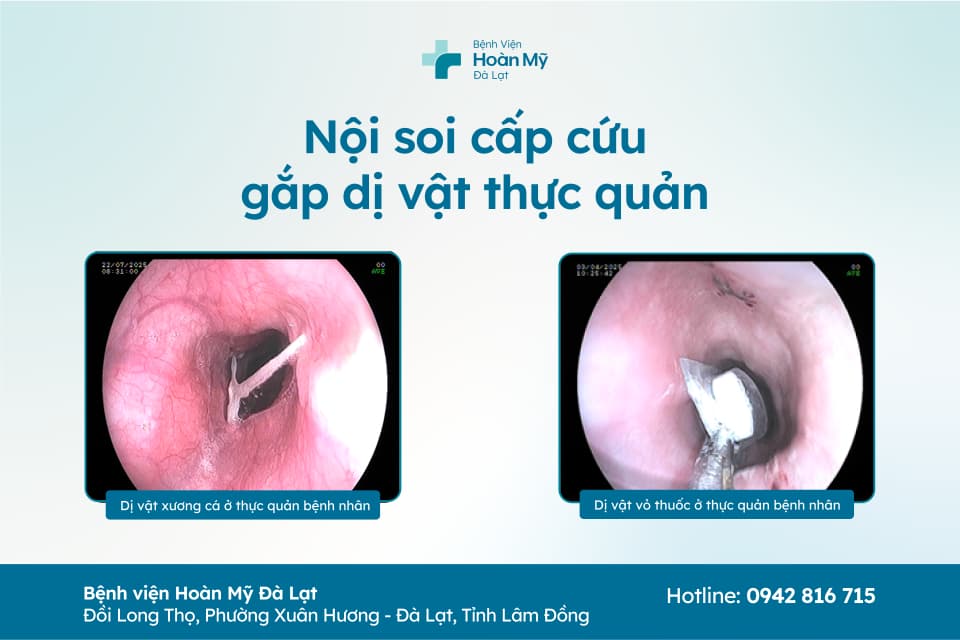 Nội soi cấp cứu thành công 2 ca nuốt dị vật ở người trung niên tại Bệnh viện Hoàn Mỹ Đà Lạt