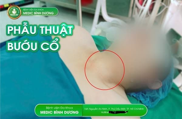 Bướu Cổ: Hiểu Rõ Để Sống Khỏe Và Tự Tin