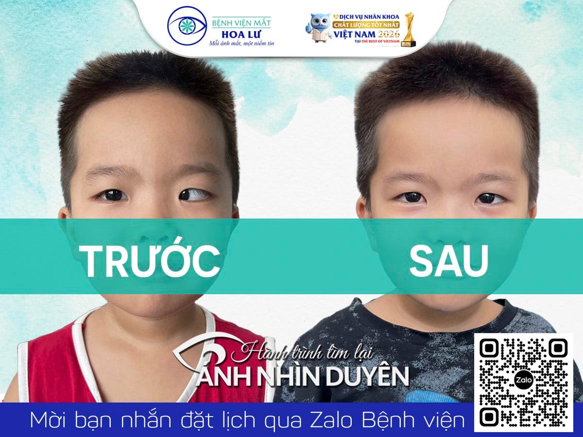 Cơ hội điều trị mắt lác cùng bác sĩ chuyên gia