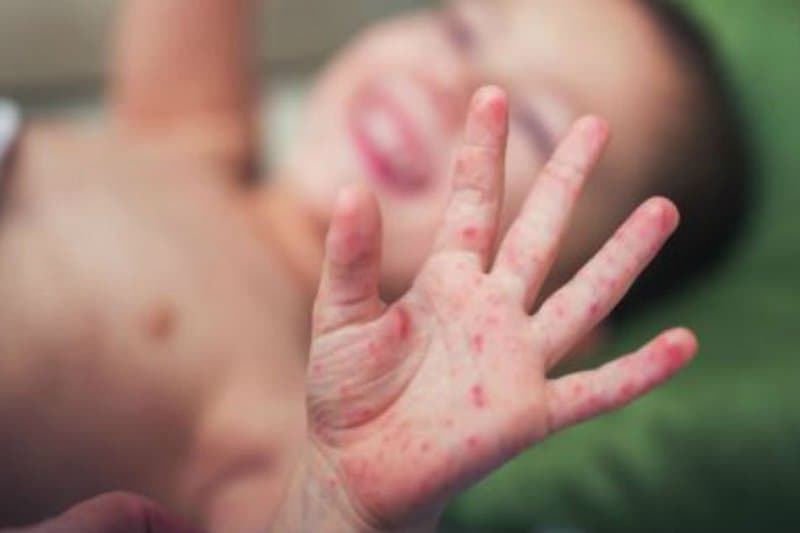 Bệnh sởi ở trẻ em lại có diễn biến nhanh và nguy hiểm?