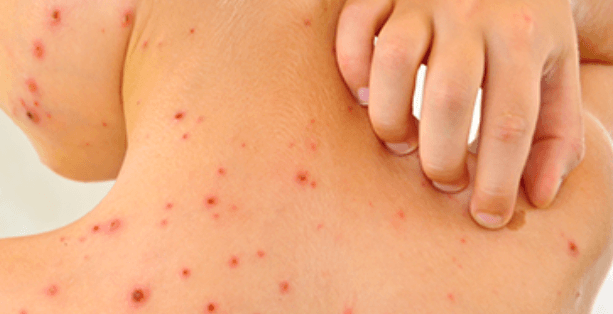 3 giai đoạn phát triển của bệnh sốt xuất huyết