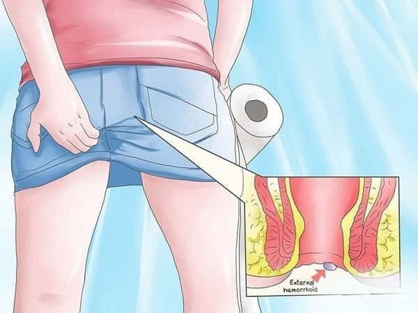 Bệnh trĩ: Khi nào cần phẫu thuật?