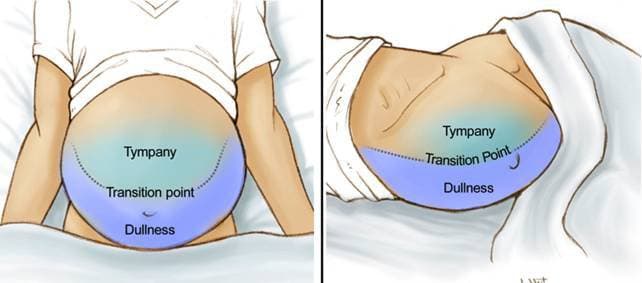 Tràn dịch màng bụng có nguy hiểm không?