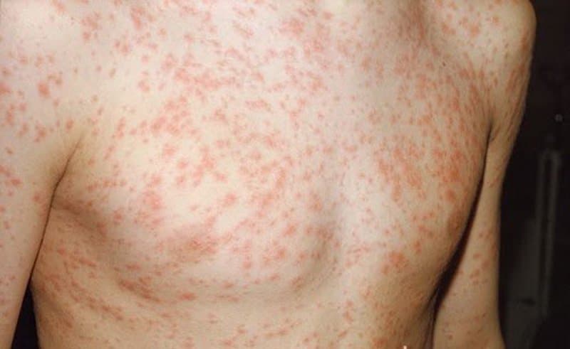 Rubella bẩm sinh là bệnh gì? Chẩn đoán và điều trị
