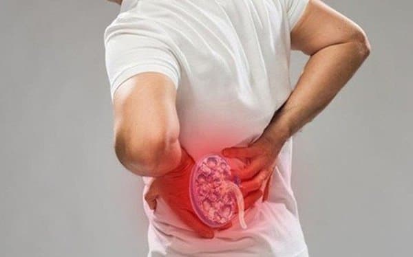 Điều cần làm sau tán sỏi thận qua da để sỏi không tái phát
