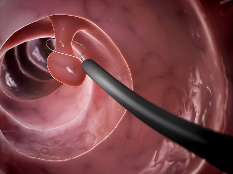 Nội soi cắt polyp ống tiêu hóa > 1cm hoặc đa polyp