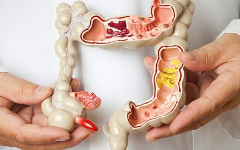 Polyp đại tràng là gì? Nguyên nhân, triệu chứng và cách điều trị