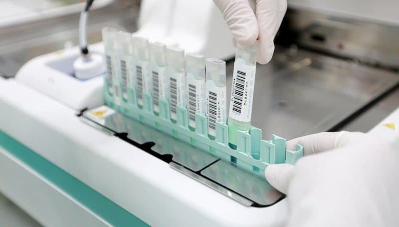 Các lưu ý trước - trong - sau xét nghiệm tìm máu trong phân