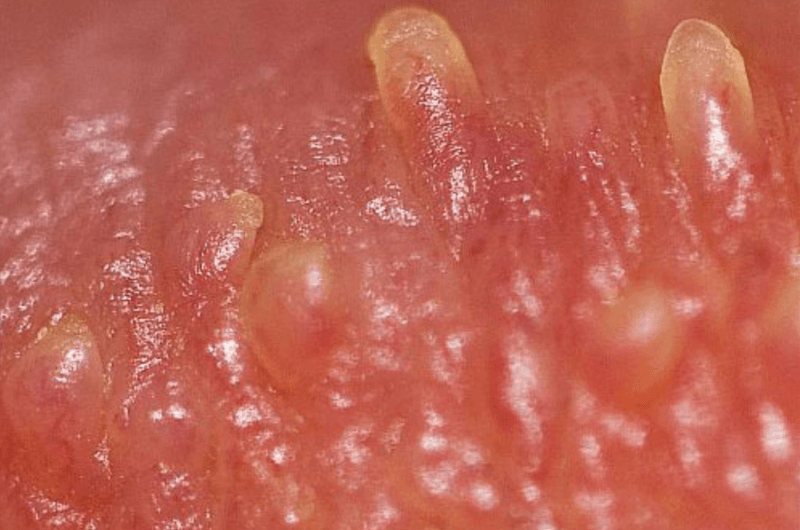 Vì sao phụ nữ dễ mắc sùi mào gà (mụn cóc sinh dục) ở vùng kín?