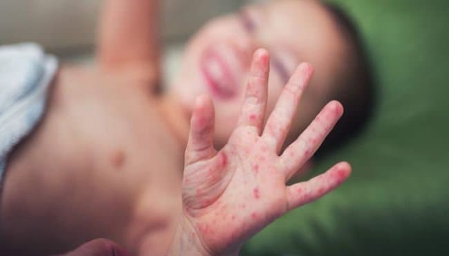 Lưu ý khi sử dụng thuốc bôi ngoài da cho trẻ bị tay chân miệng
