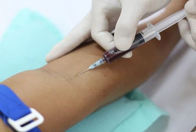 Xét nghiệm Giang mai RPR kiểm tra nguy cơ mắc bệnh