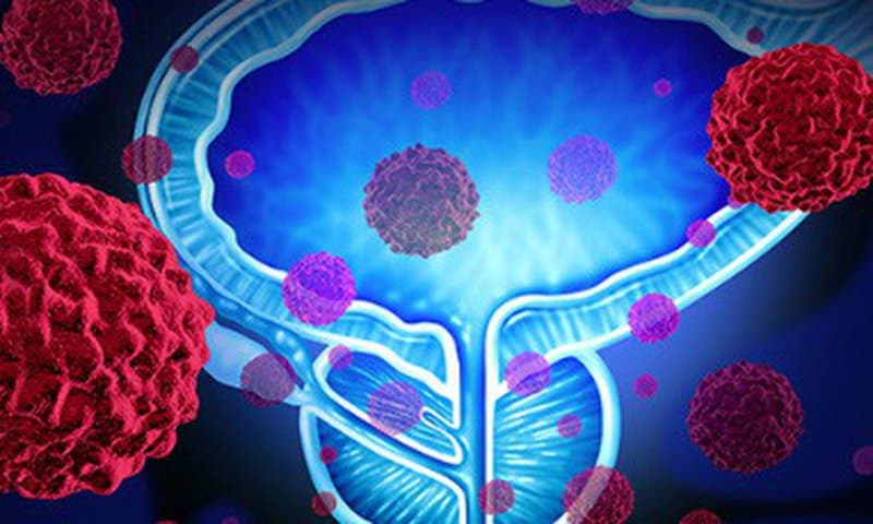 Vai trò của chụp cộng hưởng từ trong chẩn đoán ung thư tuyến tiền liệt