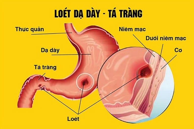 Bệnh loét dạ dày tá tràng có chỉ định mổ