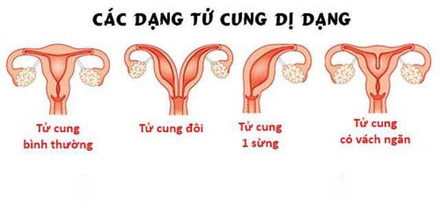 Các loại dị dạng bất thường tử cung ảnh hưởng đến khả năng mang thai