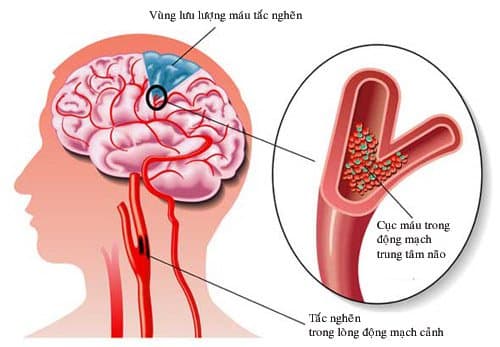 Chụp cộng hưởng từ tưới máu não (MRI perfusion) - P2