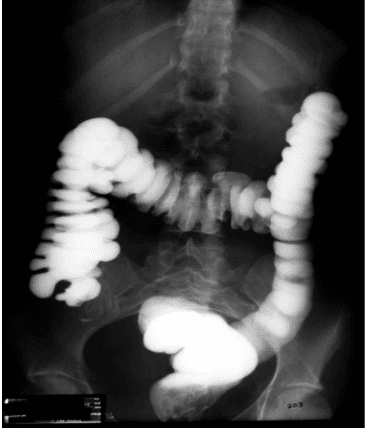 Điều trị hẹp tắc đại tràng dưới X quang tăng sáng