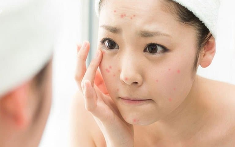 Mụn trứng cá là gì?, Có nên nặn mụn trứng cá không?