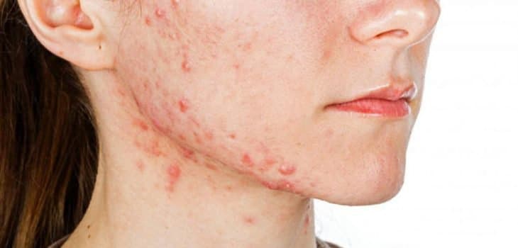 Điều trị Mụn trứng cá khôn dùng thuốc và dùng thuốc kê đơn
