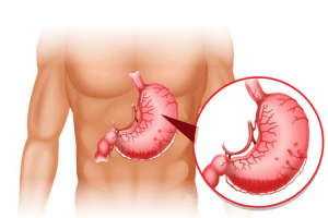 Viêm xung huyết hang vị dạ dày là gì? Nguyên nhân, triệu chứng, Điều trị, Phòng ngừa