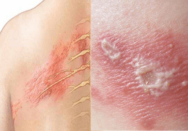 Các bệnh về da thường gặp ở người lớn: Bệnh zona, nổi mề đay và ...