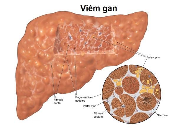 Gan nhiễm mỡ có mấy cấp độ? Có trị được không?