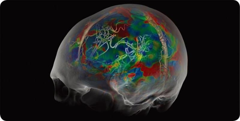 Chụp cộng hưởng từ tưới máu để chẩn đoán bệnh nhồi máu não giai đoạn cấp tính