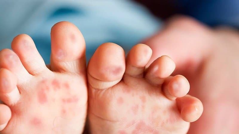 Phòng bệnh tay chân miệng, sốt xuất huyết vào mùa