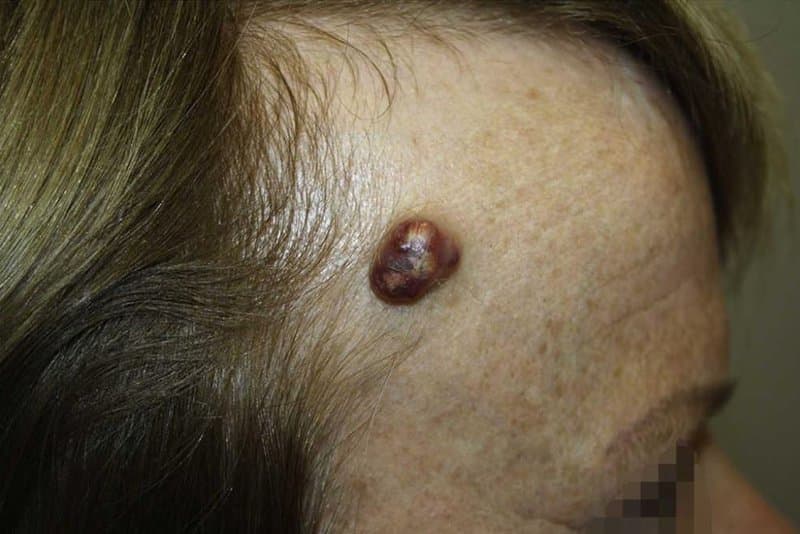 U thượng bì vôi hoá là gì? Hình ảnh U thượng bì vôi hóa (pilomatrixoma) trên siêu âm