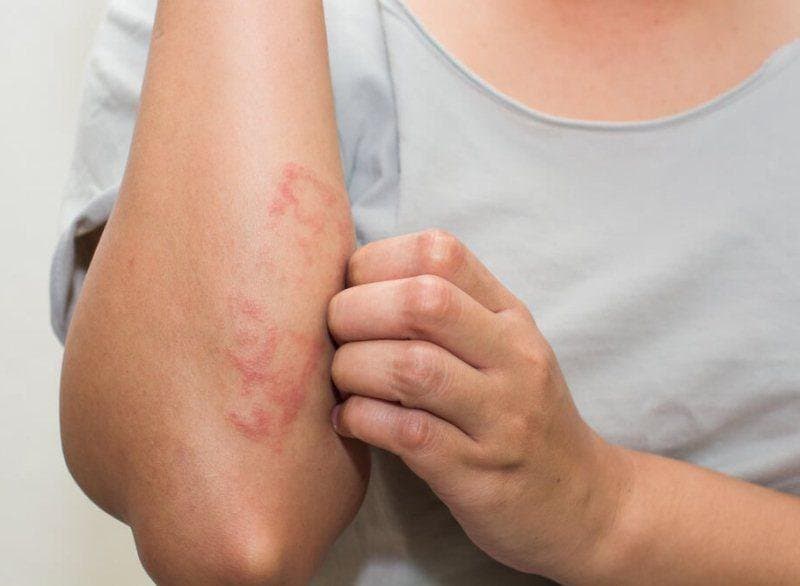 Bệnh vảy phấn hồng Gibert: Triệu chứng lâm sàng và phương pháp chẩn đoán điều trị
