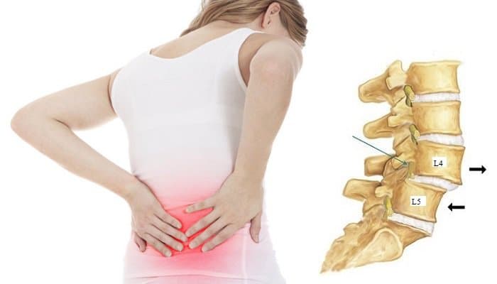 Phẫu thuật điều trị trượt đốt sống thắt lưng