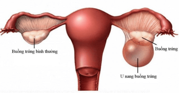Gây mê nội khí quản phẫu thuật cắt u buồng trứng hoặc bóc u buồng trứng