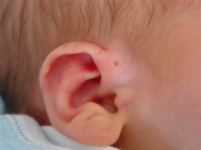 Rò luân nhĩ là bệnh gì?, dấu hiệu nhận biết và cách điều trị