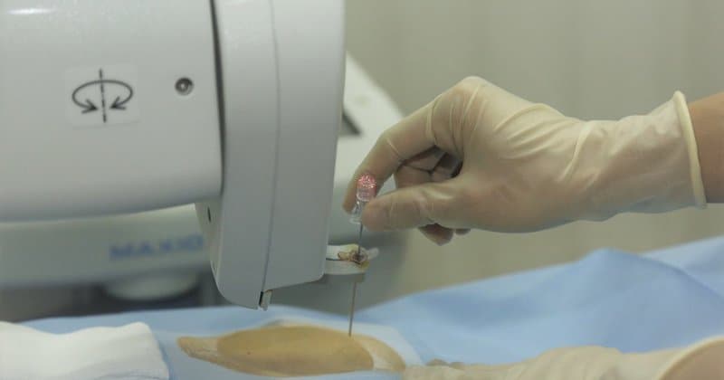 Diệt hạch điều trị đau dây V số hóa xóa nền