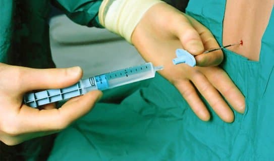 Gây tê kết hợp tủy sống - ngoài màng cứng phẫu thuật rò niệu đạo - âm đạo bẩm sinh