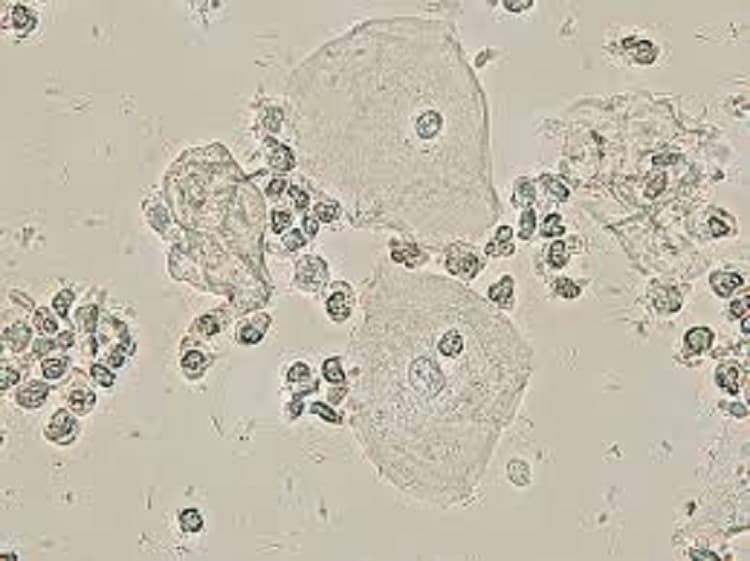 Tế bào Clue cell trong xét nghiệm soi tươi vi khuẩn âm đạo