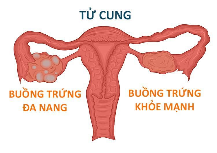 5 nguyên nhân gây đau ở buồng trứng, triệu chứng, chẩn đoán, điều trị