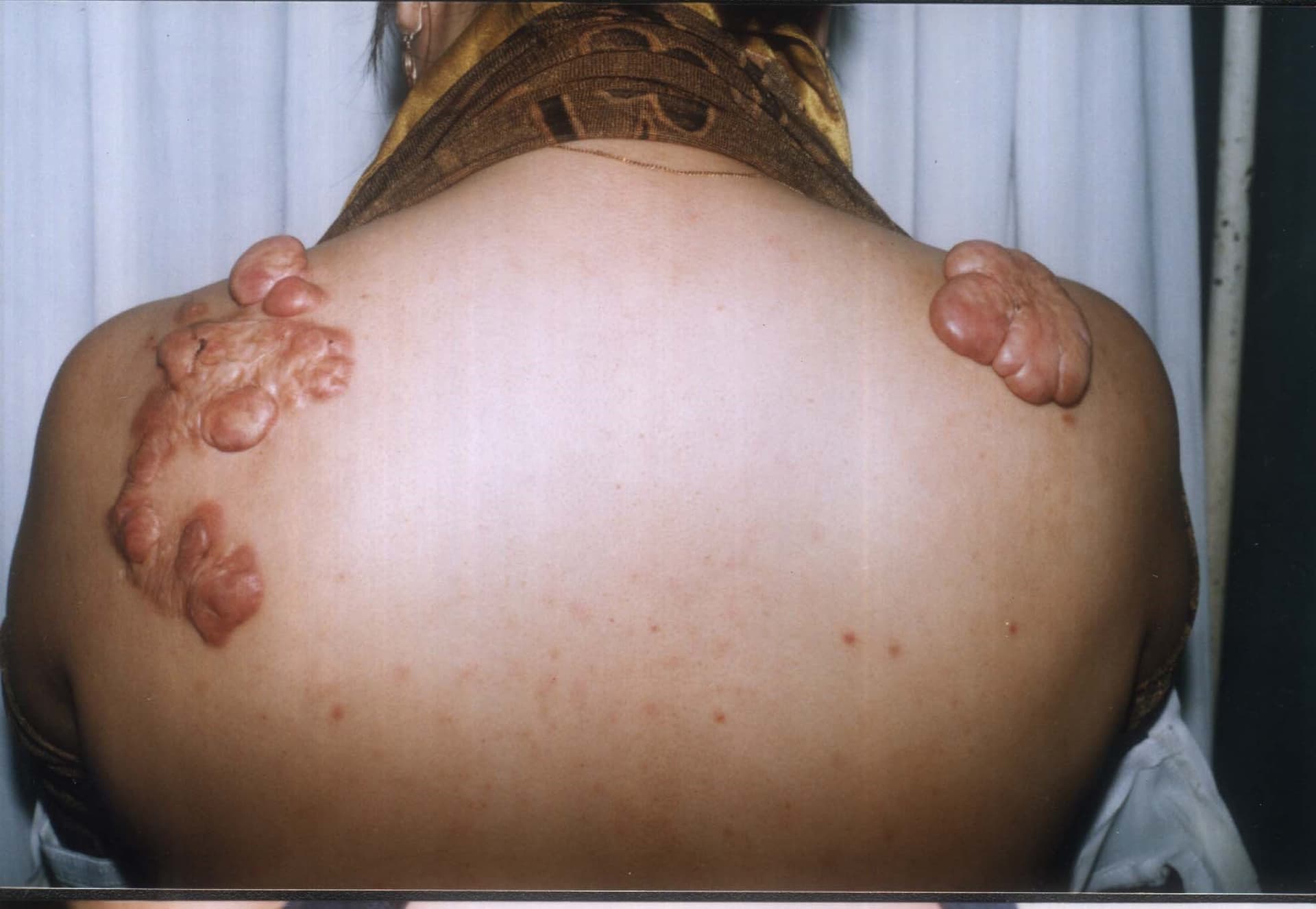 Một số loại sẹo bất thường trên cơ thể sau liền vết thương