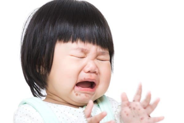 Phòng và điều trị bệnh tay - chân - miệng ở trẻ em