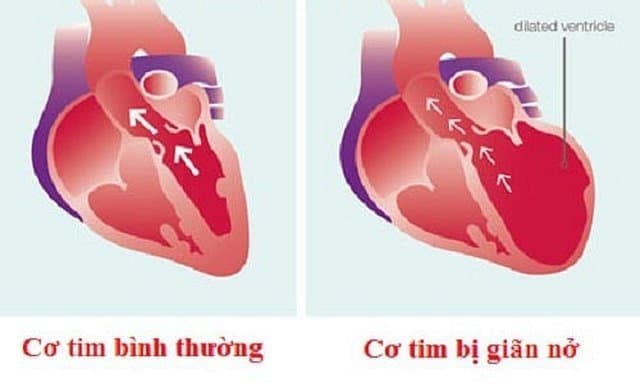 Bệnh cơ tim giãn: biểu hiện, nguyên nhân và cách điều trị